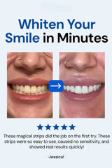 SmileBeamâ„?Wireless Teeth Whitening Kit