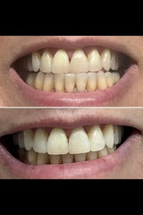 SmileBeamâ„?Wireless Teeth Whitening Kit