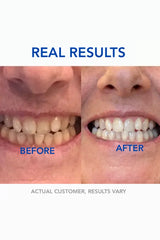 SmileBeamâ„?Wireless Teeth Whitening Kit